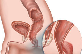 Fistula problems Maa Manasa Clinic